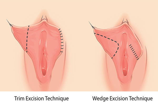 عمل زیبایی واژن عمل درمانی