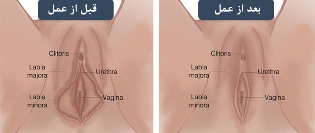 بیماری در ناحیه واژن