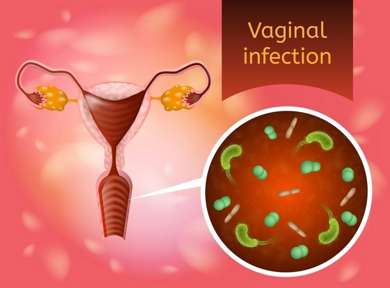 علت حالت عفونی باکتریایی واژن