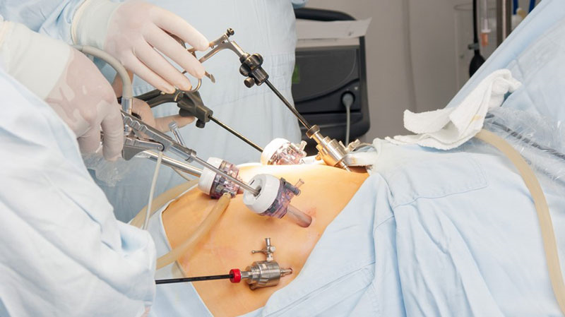 جراحی لاپاراسکوپی یکی از روشهای مدرن جراحی است